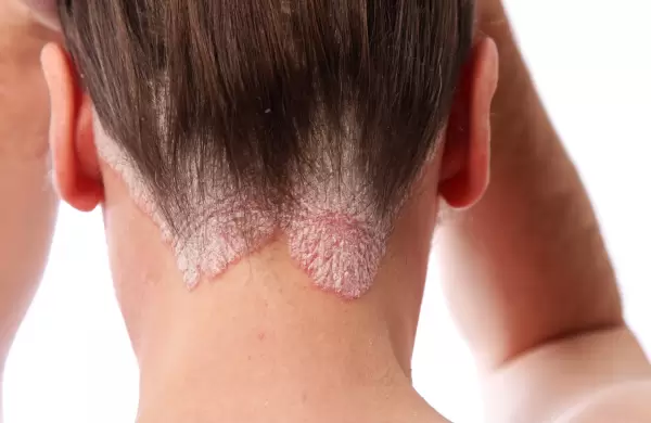 La ANMAT aprobó un nuevo medicamento para la psoriasis moderada a severa