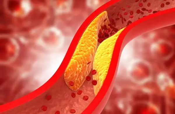 ¿Revolucionará la cardiología? Fármaco en ensayo clínico promete erradicar el colesterol malo con una sola pastilla