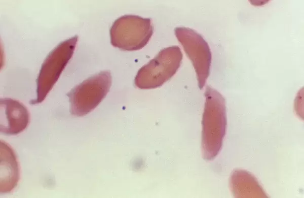 La FDA aprueba un nuevo tratamiento para un trastorno sanguneo mediante la tcnica de edicin gentica CRISPR