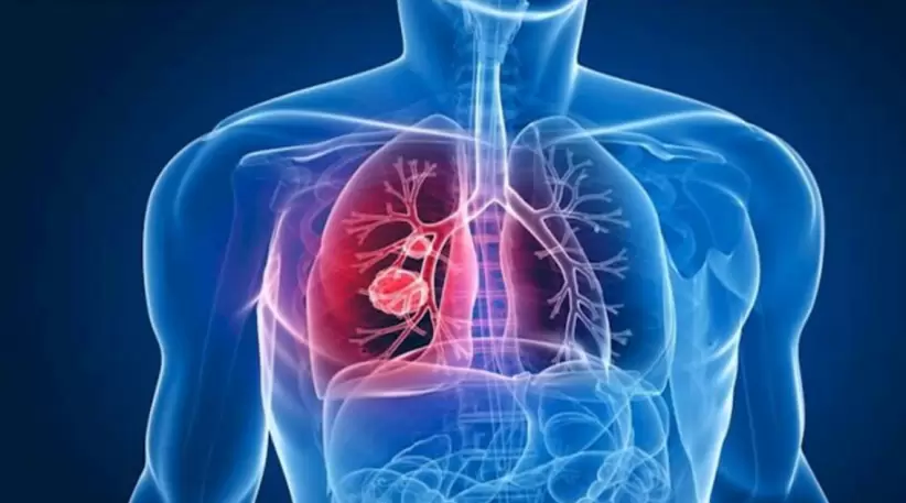 hipertensin pulmonar